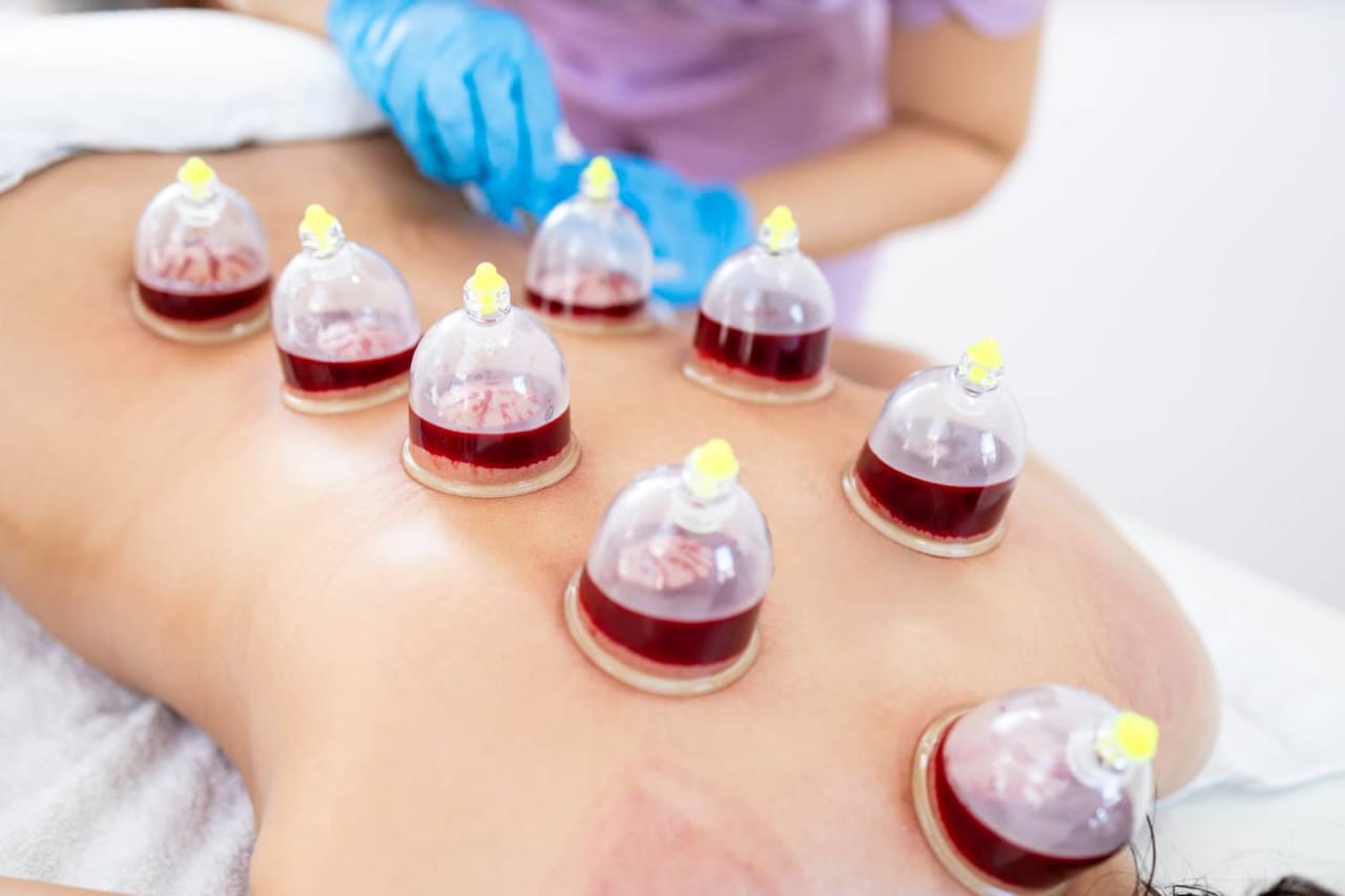 Holistic Cupping Therapy